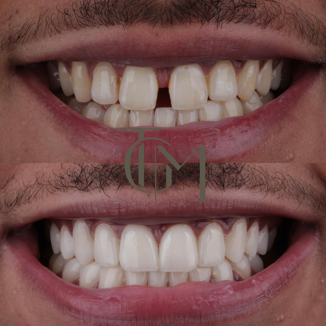 Before and after dental crowns result, The Glow Med patient, before on top and after below