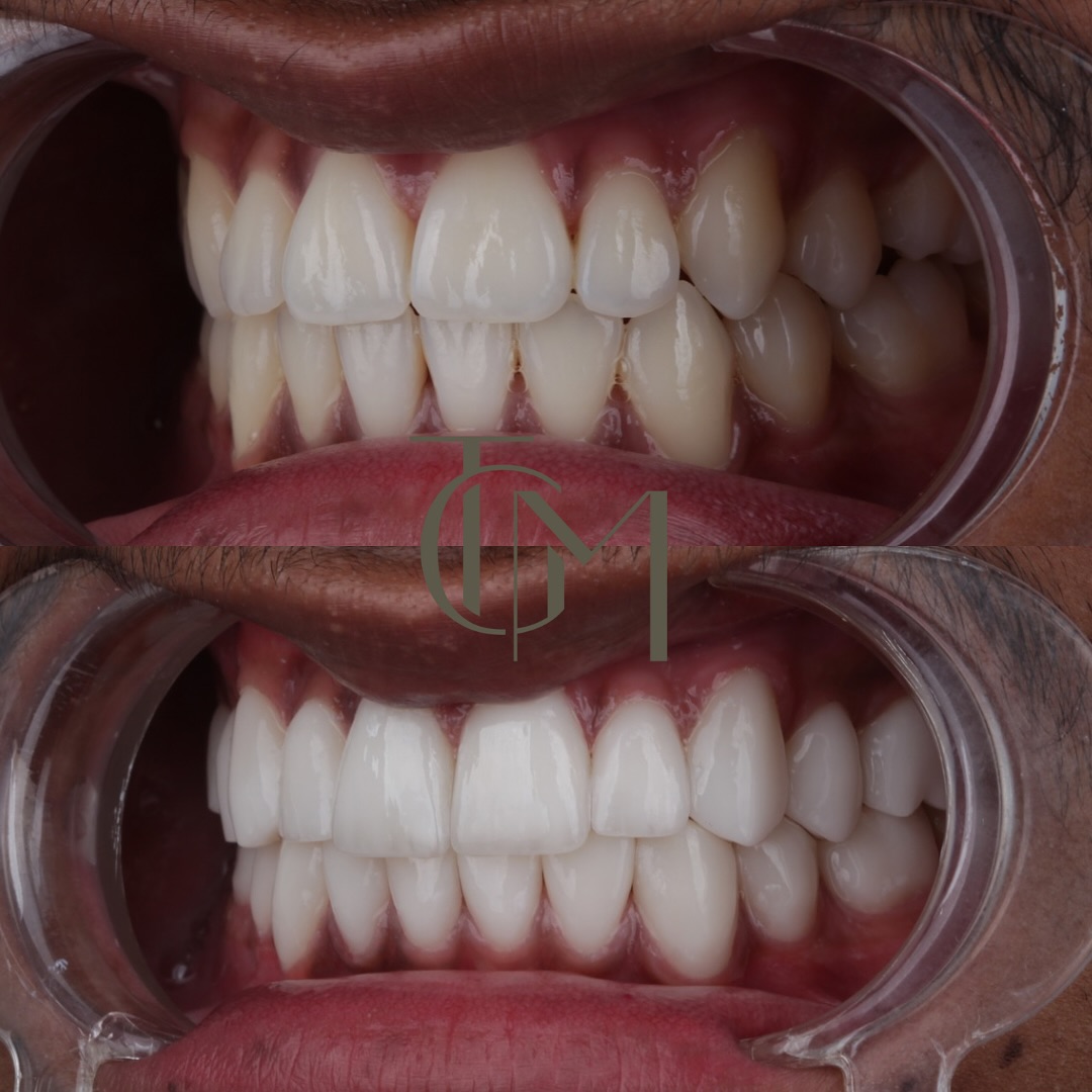 Before and after smile makeover result, The Glow Med patient, before on top and after below
