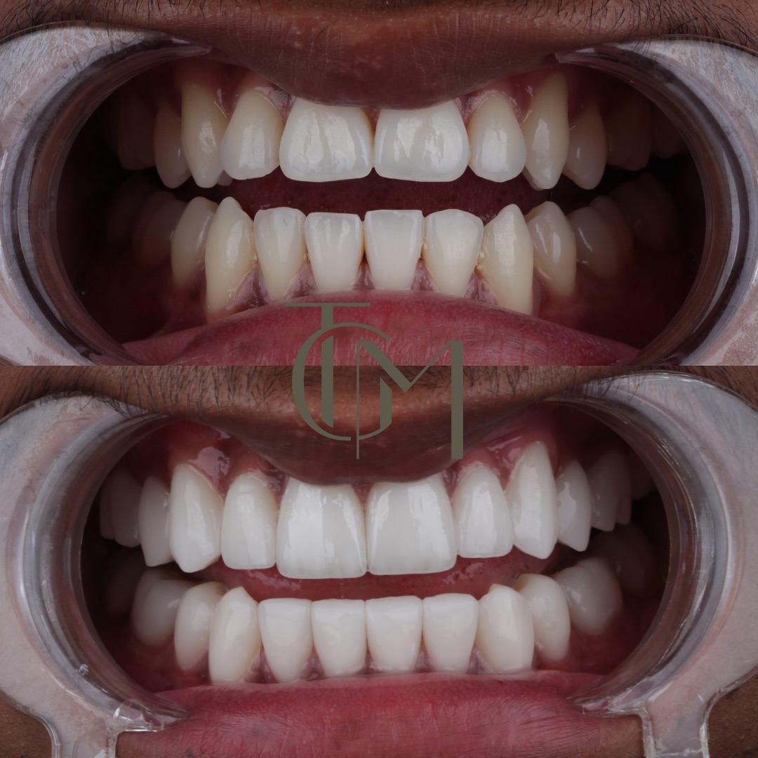 Before and after dental crowns result, The Glow Med patient, before on top and after below