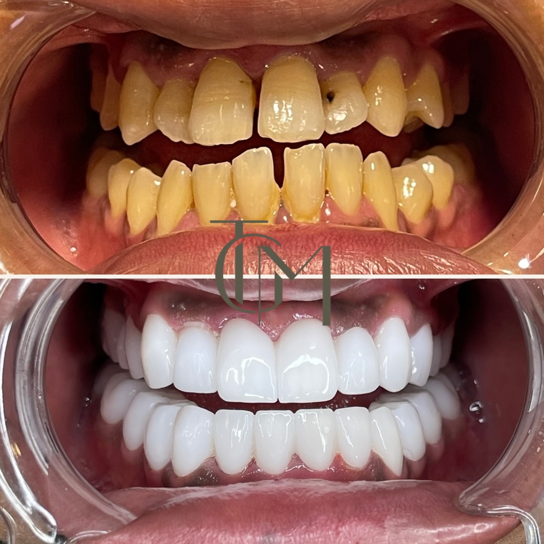 Before and after dental veneers result, The Glow Med patient, before on top and after below
