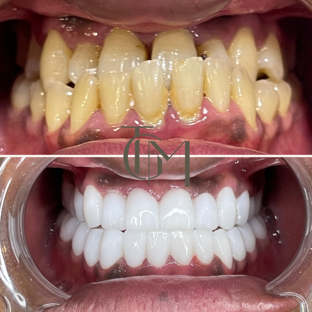 Before and after smile makeover result, The Glow Med patient, before on top and after below