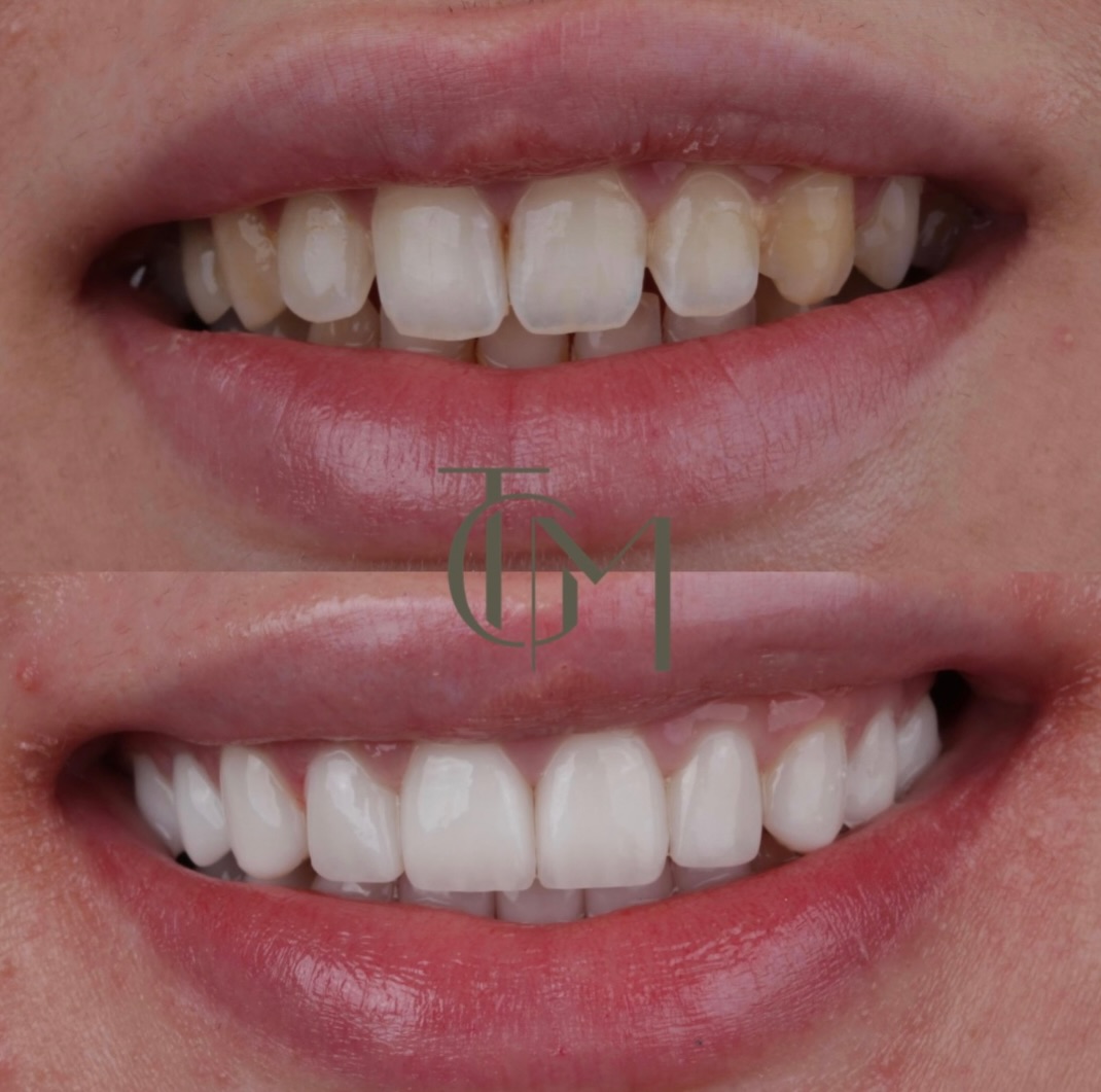Before and after dental veneers and crowns result, The Glow Med patient, before on top and after below